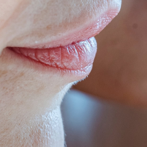 MESO ACNE